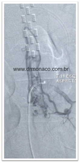 Radiografia de eletródio implantado para tratamento de dor mielopática Mielopathic pain Chronic Pain SCS Spinal Cord Stimulation 